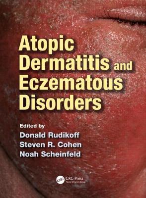 atopic-dermatitis-and-eczematous-disorders