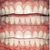 Dental Implants Key Biscayne