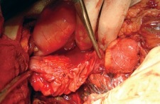 Duodenum