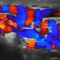 Vascular Echodoppler