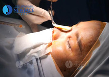 Phẫu Thuật Nâng Mũi