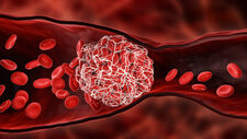 thrombus