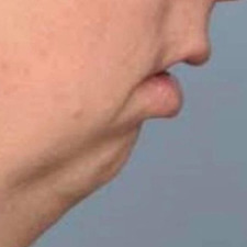 Chin